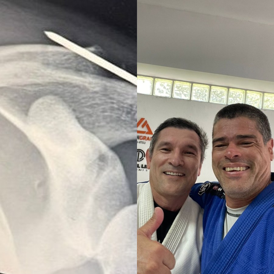 Client rehab case — 6th degree shoulder separation back to training