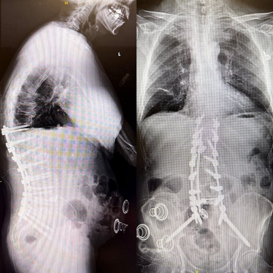 Client rehab case — spinal fusion recovery